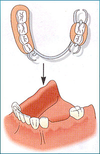 部分義歯(部分入れ歯)